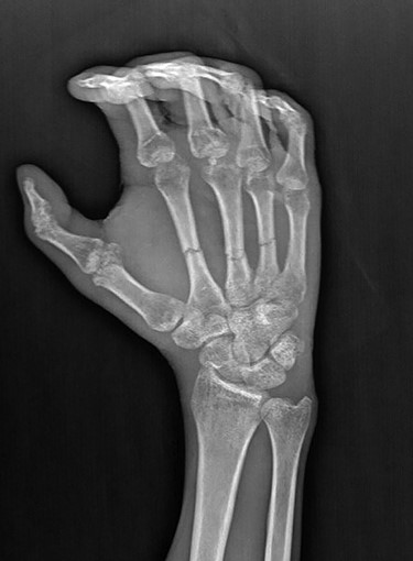 X-ray radiograph after K-wire removal.