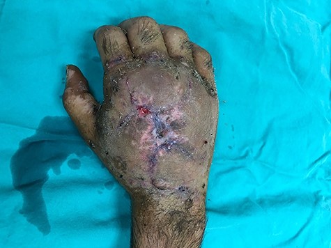 The hand in the sixth postoperative month.
