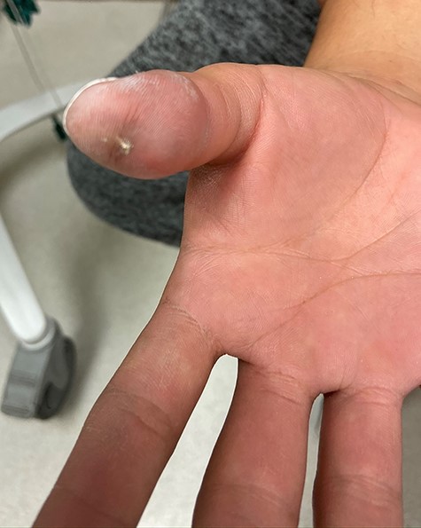 Initial injury; presentation of injection site 30 h after initial injury.