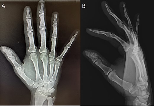 Initial injury radiographs; anterior–posterior (A) and lateral (B) radiographs of initial injury showing radiopaque material at the distal phalanx.