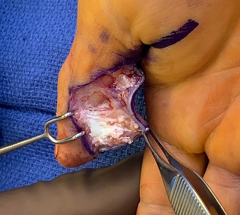 Initial irrigation and debridement; white paint can be seen invading the soft tissue, photo taken intraoperatively.