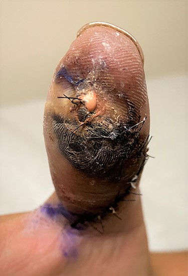One-week post-op following initial I&D; white paint can be seen draining from surgical incision, photo taken at 1 week follow-up.