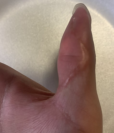 Follow-up; surgical wound seen healing well 14 weeks after second I&D.