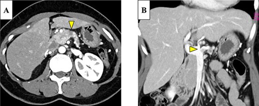 (A) Enhanced computed tomography (CT) showed a 25-mm nonhypervascular enhancing mass in the pancreatic body, which was accompanied by atrophy of the distal pancreatic parenchyma, and the upstream main pancreatic duct (MPD) was dilated to 11 mm in diameter (yellow arrow). (B) The mass also invaded the splenic vein (yellow arrow).