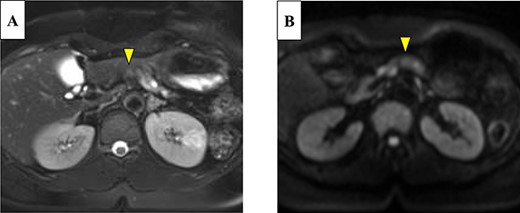 On magnetic resonance imaging, the pancreatic tumor is shown as a hyperintense area in T2- (A) and (B) diffusion-weighted images (yellow arrows).