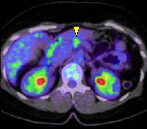 The pancreatic tumor exhibited greater uptake of 18F-fluorodeoxyglucose (standardized uptake value of 3.8) on positron emission tomography (yellow arrow).
