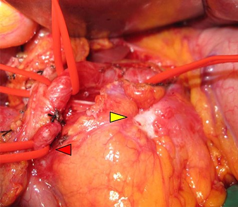 Intraoperative view: serosal exposure of the tumor was confirmed in the pancreatic body (yellow arrow), and the gastroduodenal artery was shown (red arrow).