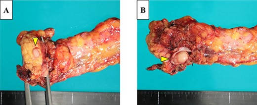 The resected pancreas contained a yellow mass that extended within the lumen of the MPD (A) and tumor thrombus in the splenic vein (B).