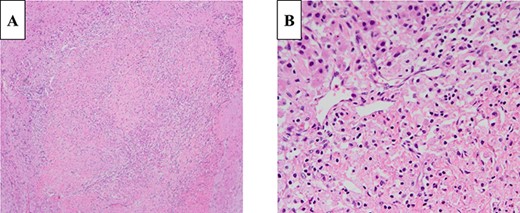 Histologically, the tumor was composed of cells containing ellipsoidal eccentric nuclei and eosinophilic cytoplasm in a rosette-like arrangement (A: 100×, B: 400×; H&E staining).