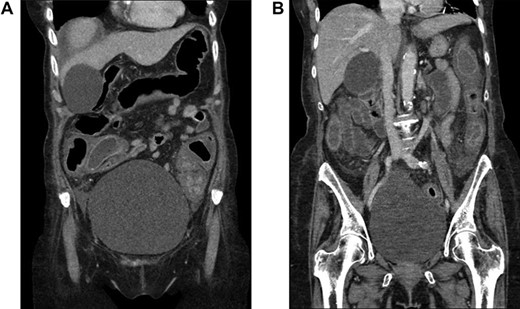 CT scan of the abdomen and pelvis demonstrating pancolitis from CDI.