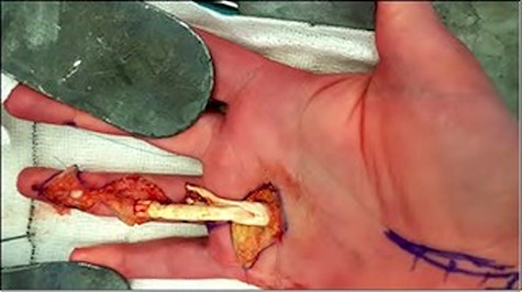 Image showing FDS and FDP avulsion in the RRF in zone 1.