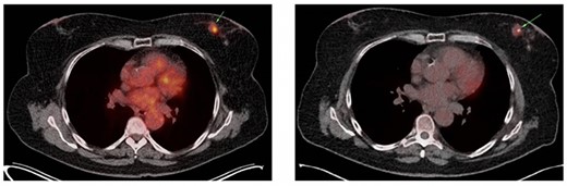 (A) Axial slice of a thoracic PET/CT showing the lobular carcinoma in the left mamma (green arrow) before neoadjuvant chemotherapy. This PET/CT was performed 7 months prior to ER presentation. (B) Axial slice of a thoracic PET/CT showing the lobular carcinoma in the left mamma (green arrow) after neoadjuvant chemotherapy with partial response. This PET/CT was performed 7 weeks prior to ER presentation.