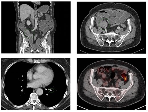 Coronal (A) and axial slice (B) of the abdominal CT scan at ER presentation showing small bowel obstruction with terminal ileum (green ellipse) and ileocecal junction stenosis. (C) CT scan at ER presentation also showed pulmonary embolisms in basal lung segments bilaterally (green ellipse). (2D) PET/CT performed 7 weeks prior to ER presentation showed no 18FDG uptake terminal ileum or ileocecal junction.