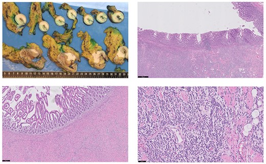 Macroscopic findings (A): in the longitudinal section of the cecum, there was no mucosal ulceration found. In the terminal ileum a stenosis was observed due to a submucosal circular pale mass. In the colonic wall and mesocolon, a hard pale mass was found too. Microscopic examination of the terminal ileum (B) and colon (C) showed that the mucosal layer was intact. The tumor cells with linear growth and loss of cohesion (D) were spread from the serosal to the submucosal layer (hematoxylin and eosin staining). Black bar indicates 500, 200 and 50 μm for Fig. 3B–D, respectively. The unexpected histological finding with lobular features, similar to the oncoplastic breast-conserving surgery specimen of the left breast, prompted further immunohistochemical study. In both the terminal ileum and in the cecum, the tumor cells were strongly positive for cytokeratin 7 (CK7), GATA-3 and estrogen receptor (ER). The tumor cells were negative for HER2 and progesterone receptor (PR) (similar to the pattern found in in the breast tumor). The markers of enteric differentiation: cytokeratin 20 (CK20), CDX-2 and carcinoembryonic antigen (CEA) were all negative. The positive staining of GATA-3, ER and CK7 is highly consistent with metastatic disease from the primary breast carcinoma.