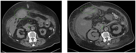 CT scans performed at the 8th (A) and 25th (B) postoperative day showed a decreasing rectus sheath hematoma (green ellipse), increasing free intraperitoneal fluid (green asterisk) and blood clot progression with small air configuration near the VCF (green arrow). Also, enlargement of the blood clot at the level of the VCF, an increase in pleural fluid, bile duct dilatation and an increase in right-sided hydronephrosis were observed caused by further metastatic disease and paraneoplastic syndrome.