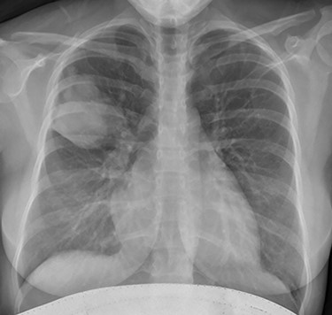 Plain chest radiograph demonstrating a right upper zone mass.
