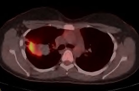 PET-CT demonstrating the right upper lobe lesion to be intensely FDG avid.
