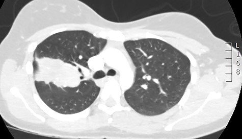 CT scan demonstrating the large apparent right upper lobe mass.