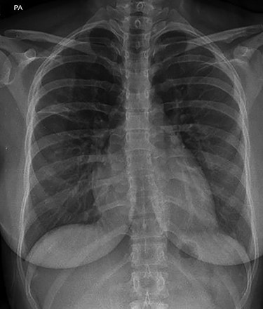 Plain chest radiograph demonstrating resolution of the right upper zone mass.