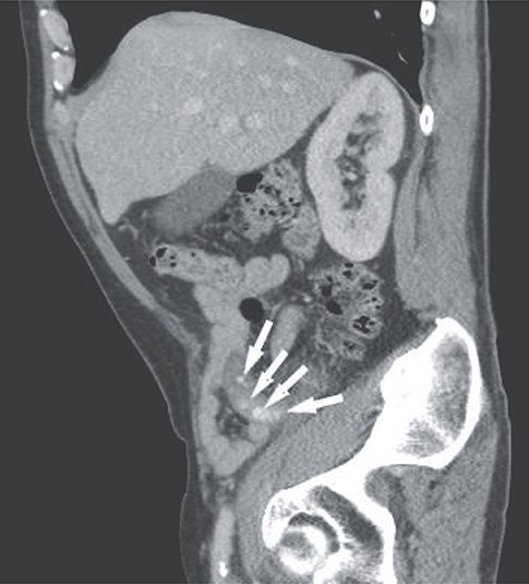Sagittal view of the abdominal CT showing multiple appendicoliths within a dilated appendix (white arrows).