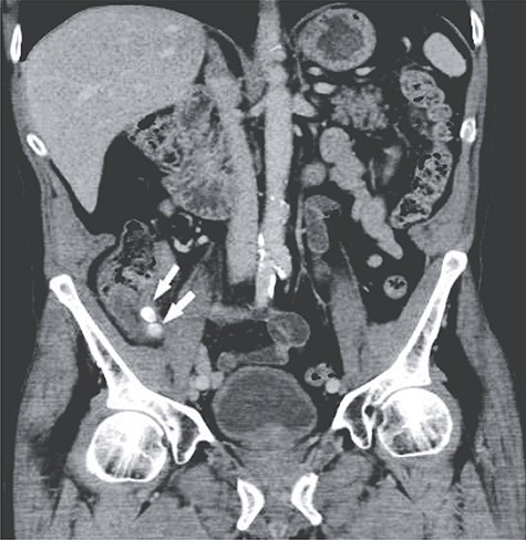 Coronal view showing two of the larger appendicoliths at the appendix base (white arrow).