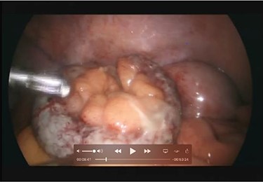 Intraoperative picture demonstrating the inflamed and coiled appendix with signs of transmural necrosis.