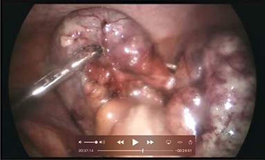 Intraoperative picture demonstrating the inflamed and coiled appendix with signs of transmural necrosis.