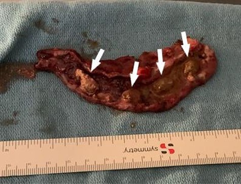 The transected appendix with four easily identified appendicoliths (white arrow).
