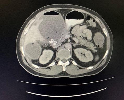 Axial view of CT scan of the abdomen with oral contrast demonstrating enlarged, thickened gallbladder with radio-opaque gallstones. Two large liver abscesses in segment 4 measuring 116 × 80 mm (communicating with the gallbladder) and segment 6 measuring 97 × 96 mm with air locules noted.