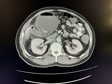 Axial view of portovenous phase of CT scan of the abdomen demonstrating enlarged, thickened gallbladder with radio-opaque gallstones with apparent fistulous communication with the hepatic flexure of the colon with associated pneumobilia.