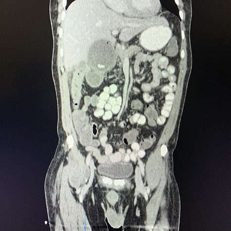 Coronal view of oral and intravenous contrasted CT scan of the abdomen demonstrating features of cholecystitis with fistulous communication with the hepatic flexure of the colon with associated pneumobilia.