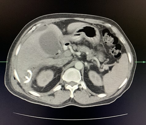 Axial view of arterial phase of CT scan of the abdomen cholecystitis with pneumobilia with resolving liver abscesses with percutaneous pigtail catheter in situ.