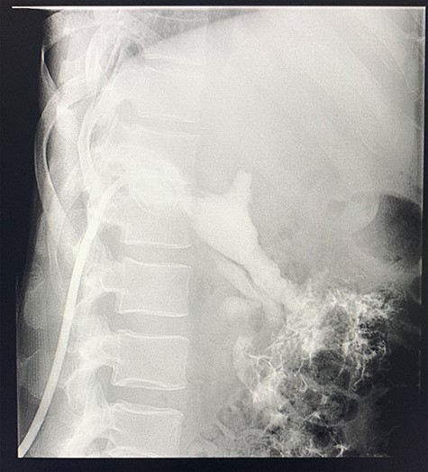 Sinogram obtained by anterioposterior x-ray of segment of lower chest/abdomen following injection of contrast into the percutaneous pigtail catheter, demonstrating passage of contrast into the hepatic flexure of the colon via an apparent fistulous connection.