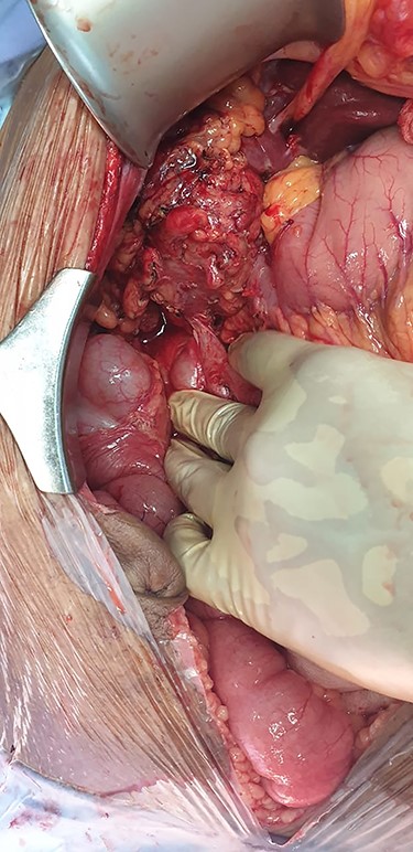 Intra-operative imaging obtained via laparotomy of the abdomen, demonstrating a fistulous connection between the hepatic flexure of the colon and an inflamed, granulomatous gallbladder.