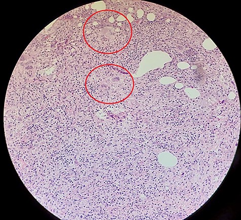 Histopathological slide with hematoxylin and eosin staining demonstrating fat (with areas of fat necrosis) and fibrous connective tissue. Dense infiltrate of foamy histiocytes (circled) with associated plasma cells and lymphocytes noted, together with surface ulceration suggestive of chronic xanthogranulomatous inflammation.
