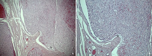 (a) Low power hematoxylin and eosin stain showing a subcutaneous tumour composed of lobules of pleomorphic epithelioid cells. (b) High power photomicrograph showing a multi-nodular nested architecture separated by fibrovascular septa, and a perivascular arrangement of cells reminscient of pseudorosettes.
