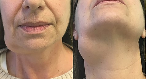 Frontal view of the mass.