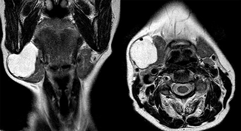 Coronal and axial view of T2-weighted MRI.