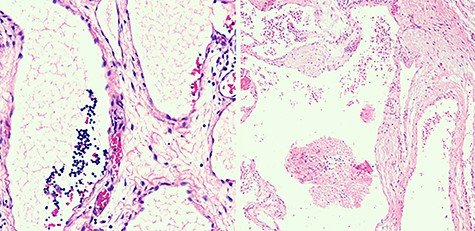 Histological view of dilated lymphatic vessels of CL.