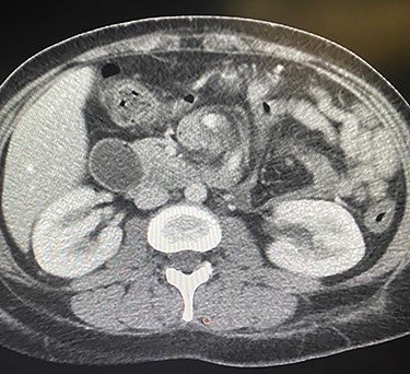 CAT scan showing partial small bowel obstruction with adhesive band originating from the stomach.