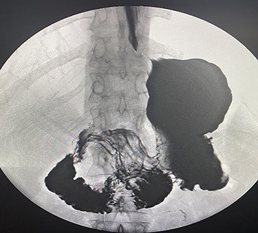 Barium meal showed dilatation of the second part of duodenum due to band like structure.