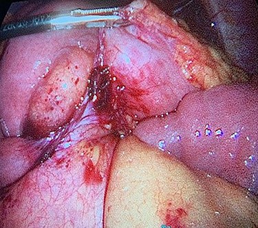 Band caused by suture penetrating the stomach wall.