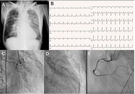 Preoperative chest X-ray (A), electrocardiogram (B) and coronary angiography: right coronary (C), and left anterior descending and left circumflex (D), and right coronary artery (E).