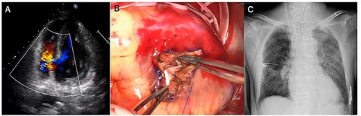 Transesophageal echocardiography showed a defect with a left-to-right shunt (A). Ventricular septal perforation (VSP) (B). Postoperative chest X-ray (C).