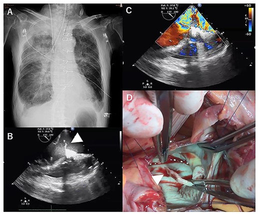 X-ray at 14 days after first operation (A). transthoracic echocardiographic images showing posterior papillary muscle rupture (arrowhead, B) (C). Posterior papillary muscle rupture (arrowhead, D).