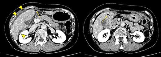 Contrast-enhanced abdominal computed tomography showing free air (arrow) and ascites (arrowhead) around the liver and duodenal perforation.