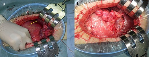 Intraoperative findings showing duodenal perforation (arrow) (a) and repair using LTH (b).