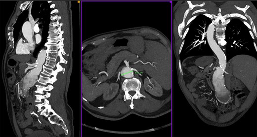 Angio-CT scan showing 7 cm pararenal aortic aneurysm.