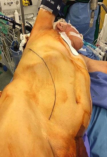 Operative room view showing mirrored setup as compared to routine thoraco–phreno–laparotomy access.