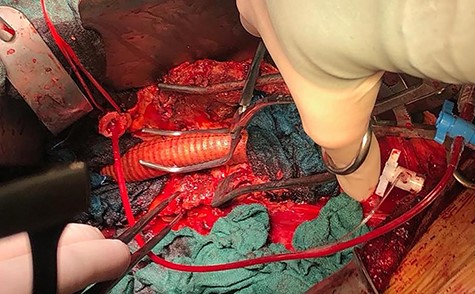 Intraoperative view showing left renal artery replacement on the tube graft with T-L anastomosis, renal perfusion guaranteed by Anatomically right heart bypass.